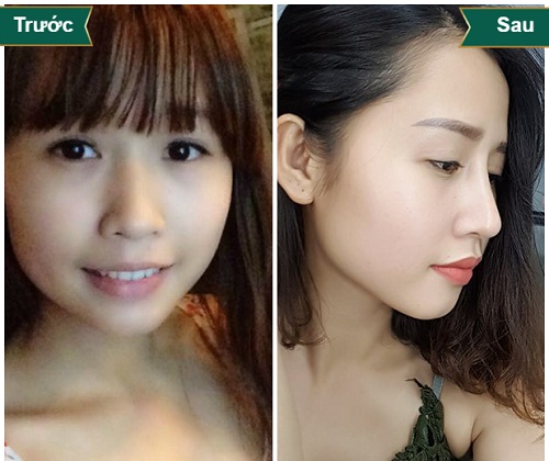 Nâng mũi bọc sụn giá bao nhiêu? Công nghệ An Toàn Chi Phí thấp - Hình 3 Nâng mũi bọc sụn giá bao nhiêu? Công nghệ An Toàn Chi Phí thấp - Hình 3