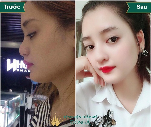 Nâng mũi để được bao lâu ? Bật mí bí kíp Nâng Mũi Đẹp Vĩnh viễn 5d0da3708a9068af0e000af7_sua-mui-pha-tuong-9