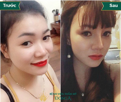 Topics tagged under 1 on Diễn đàn Tuổi trẻ Việt Nam | 2TVN Forum 5d0da3708a9068b94a000ad0_nang-mui-boc-sun-vanh-tai-1