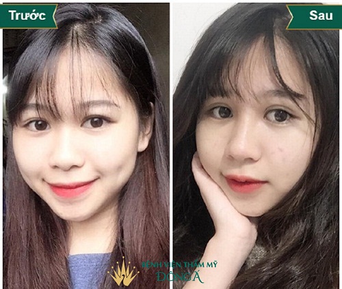 Nâng mũi để được bao lâu ? Bật mí bí kíp Nâng Mũi Đẹp Vĩnh viễn 5d0da3708a9068c25f000ae0_mui-cao-la-gi-6