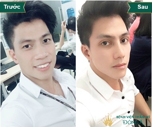 Các tướng mũi phú quý mang lại Giàu Sang và Cách để sở hữu nó - Hình 4