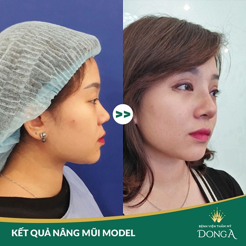 Nâng mũi bọc sụn giá bao nhiêu? Công nghệ An Toàn Chi Phí thấp - Hình 5 Nâng mũi bọc sụn giá bao nhiêu? Công nghệ An Toàn Chi Phí thấp - Hình 5