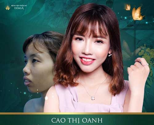 Có nên nâng mũi không? 6 Ưu, khuyết điểm khi phẫu thuật nâng mũi 5d53bec56894dd6ffa561bf8_co-nen-nang-mui-khong-12