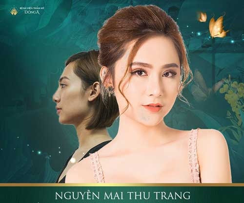 Có nên nâng mũi không? 6 Ưu, khuyết điểm khi phẫu thuật nâng mũi 5d53bec7a011490053a92ab7_co-nen-nang-mui-khong-11