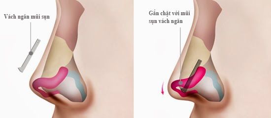 4 Video nâng mũi bằng sụn tự thân Cận Cảnh chi tiết Quy Trình 5d53bff17fa9772f0311767f_video-nang-mui-bang-sun-tu-than-2