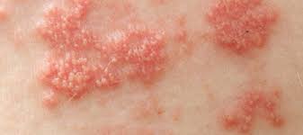 herpes sinh dục là bệnh vùng kín nam giới lây qua đường tình dục