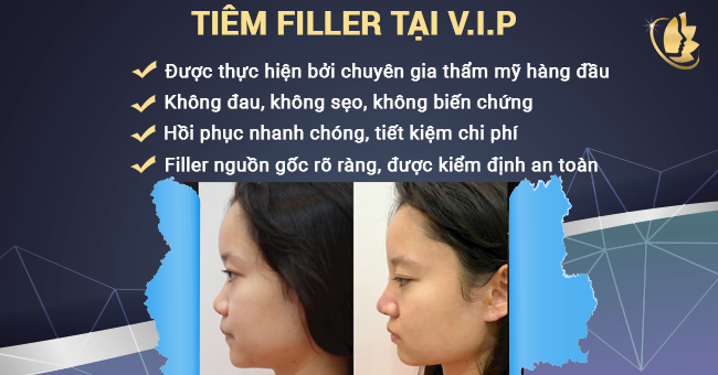 tiem-filler-nang-mui-vip-co-tot-khong