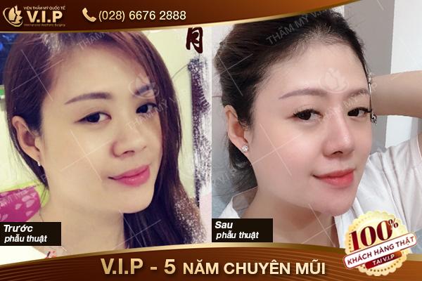 khách hàng nâng mũi tại Nâng mũi VIP