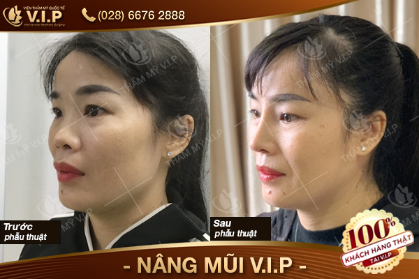 bảng giá nâng mũi Thái Lan