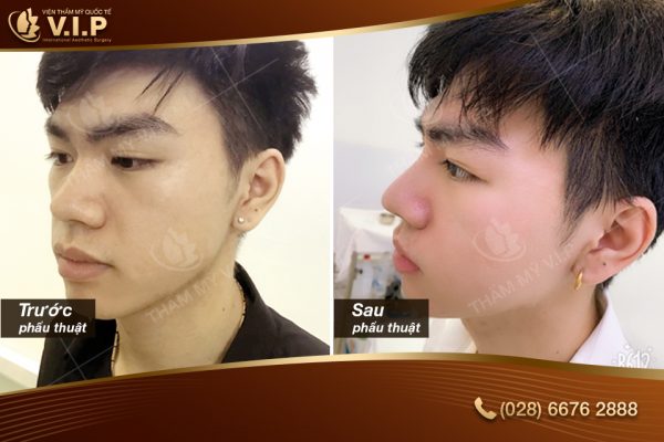 nâng mũi bao nhiêu tiền