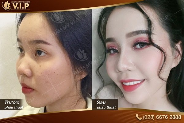 nâng mũi bao nhiêu tiền