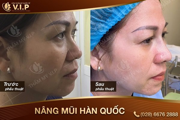 nâng mũi bao nhiêu tiền