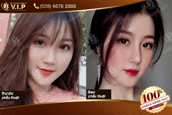Nâng mũi bọc sụn tai