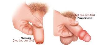 5 Cach Chữa Nghẹt Bao Quy đầu Tại Nha đơn Giản Hiệu Quả Nhất
