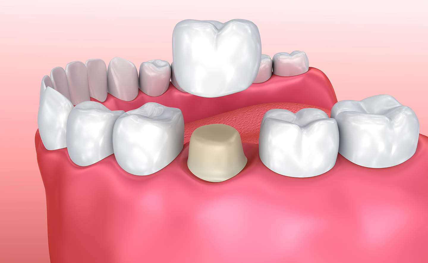 Graphic of dental crown