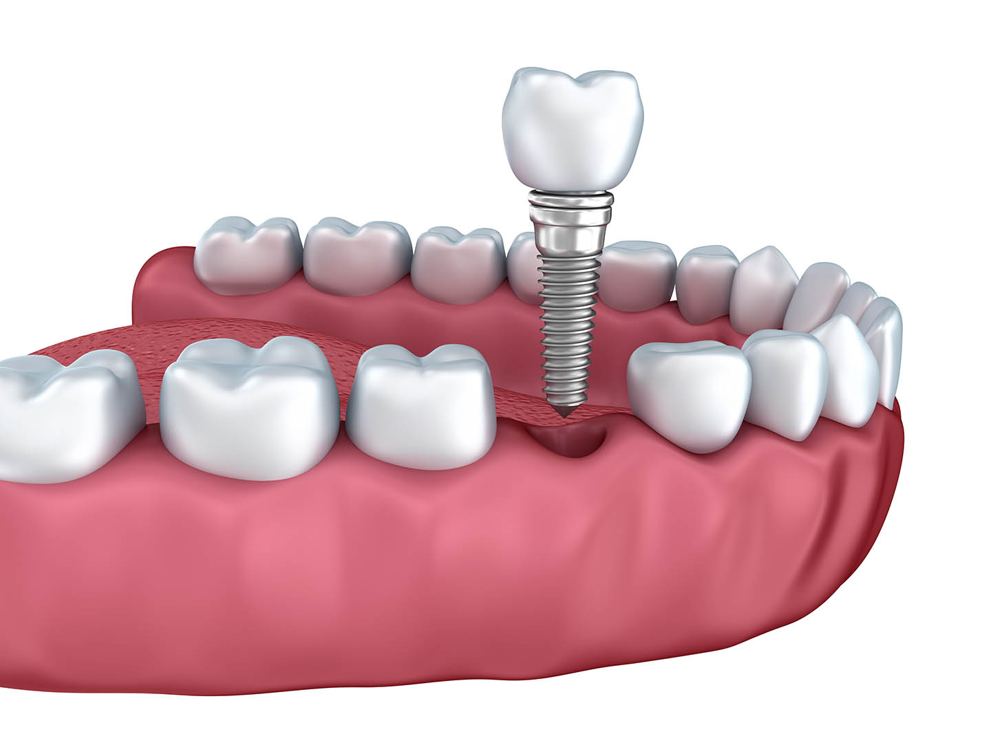 Dental Implant graphic