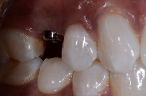 before and after treatment