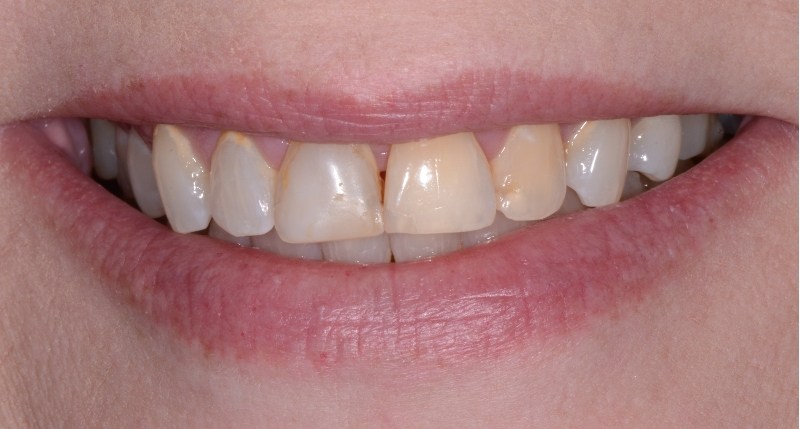 before and after treatment