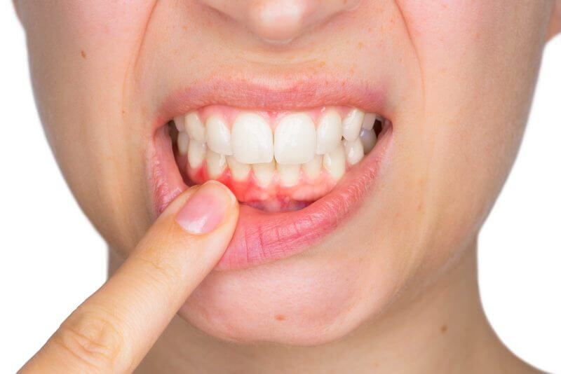 close up of periodontal disease