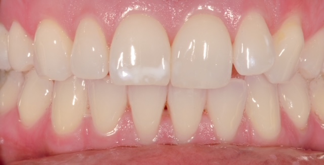 before and after treatment