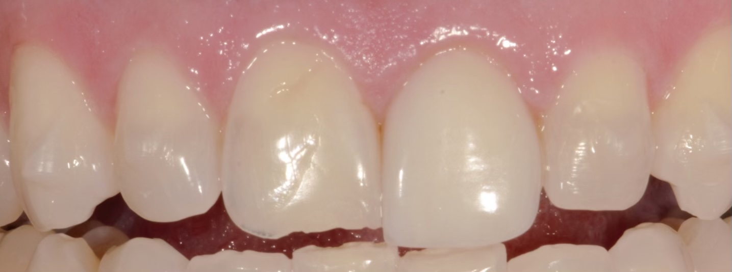before and after treatment