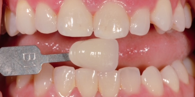 before and after treatment
