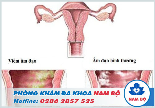 Huyết trắng khá nhiều có phải có thai không