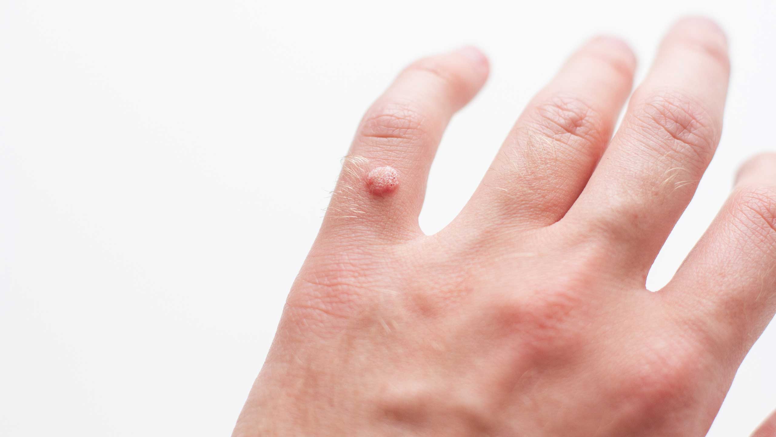 Warts
