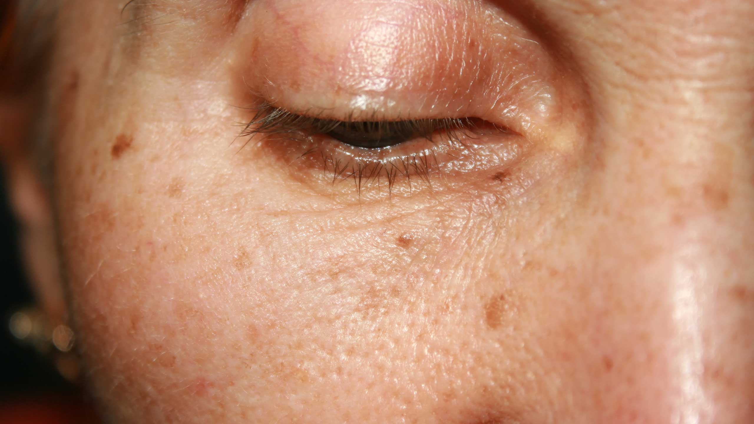 Sun Damage