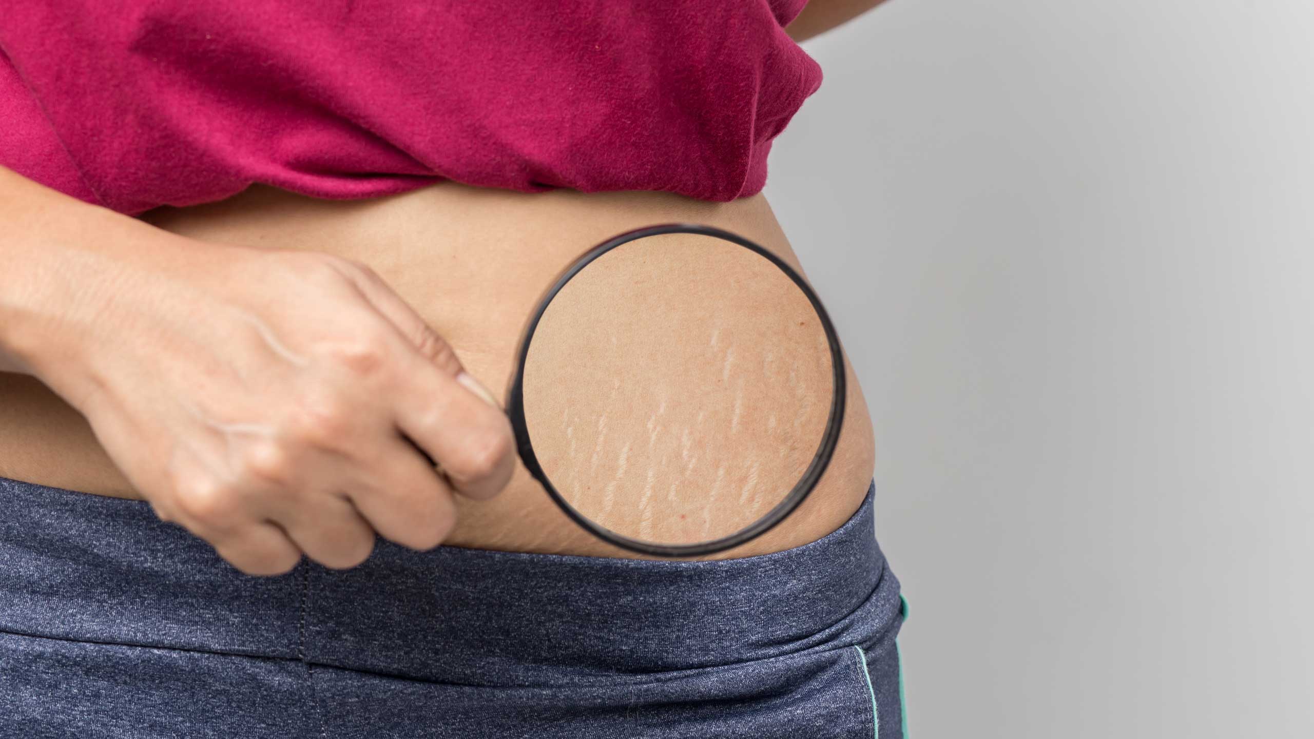 Stretch Marks