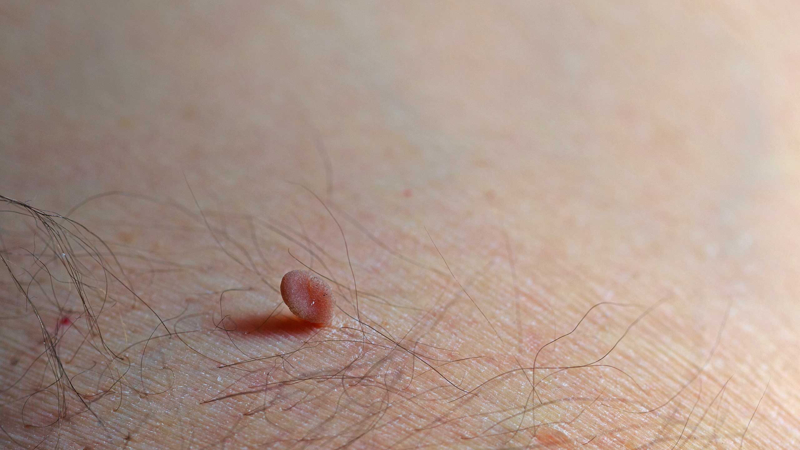 Skin Tags