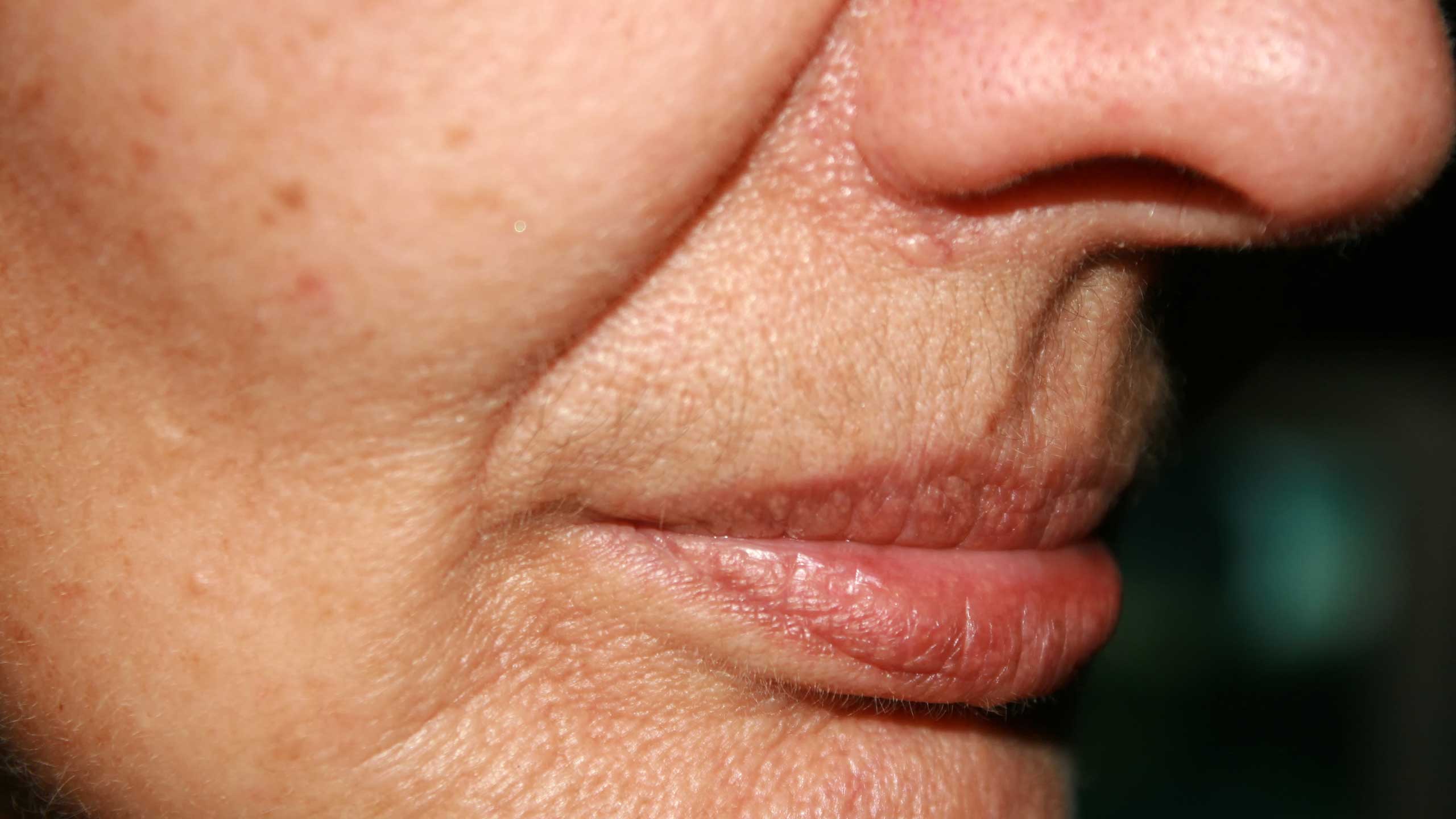 Nasolabial Folds