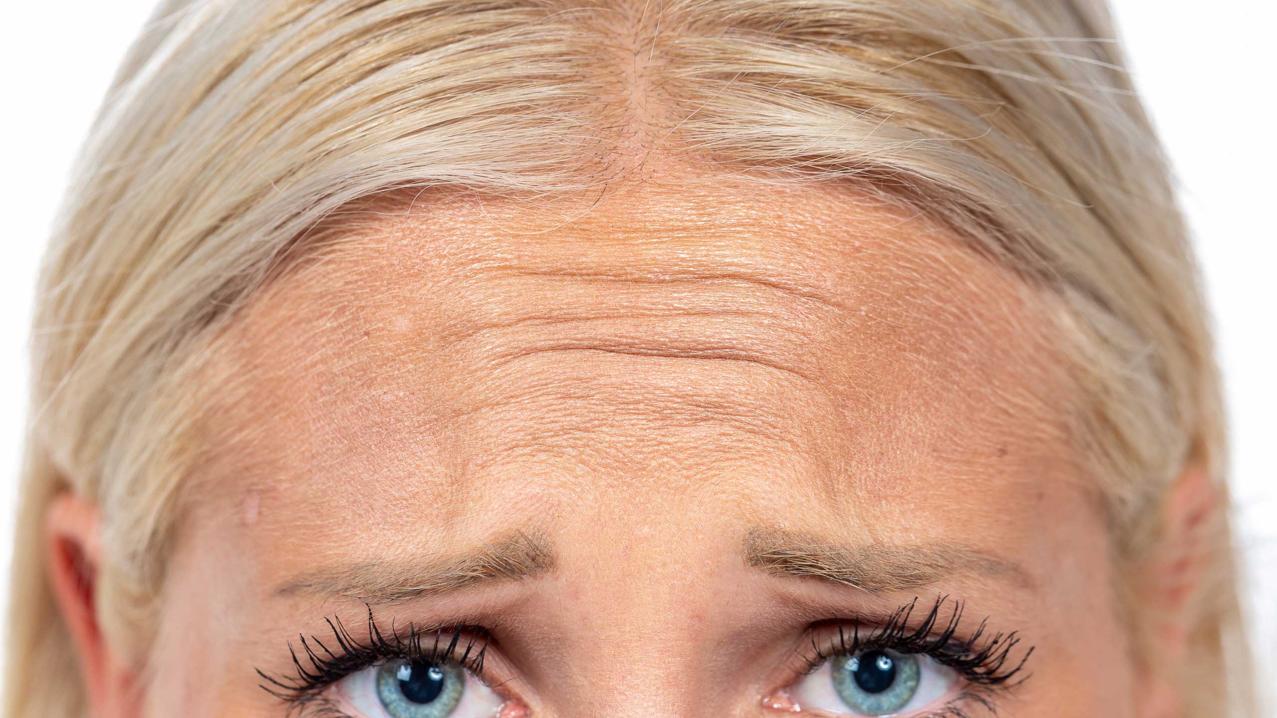 Forehead Lines