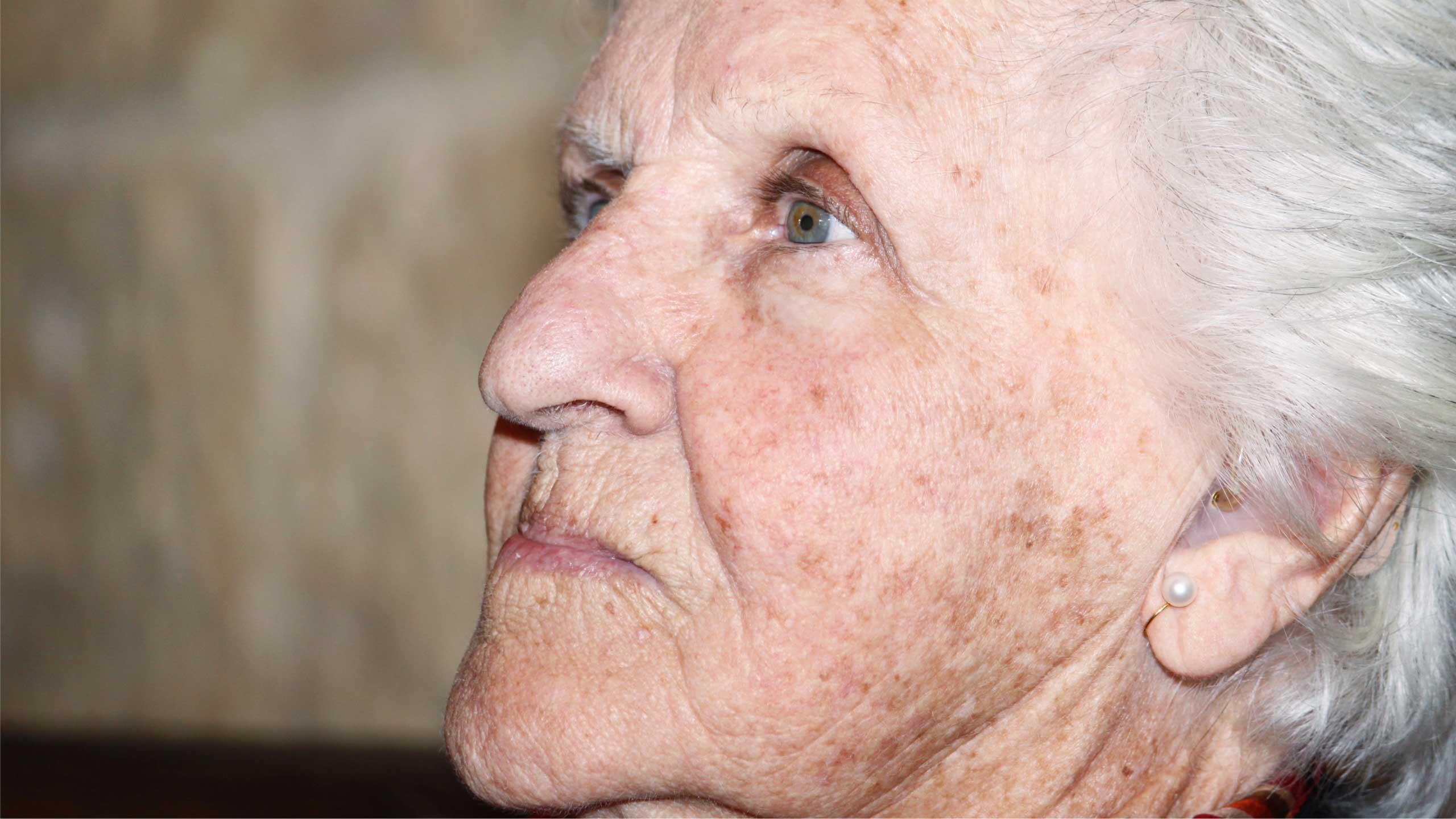 Age Spots