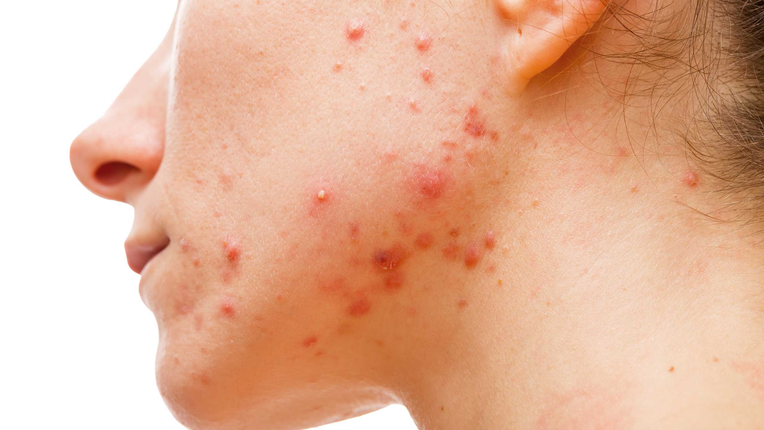 Acne