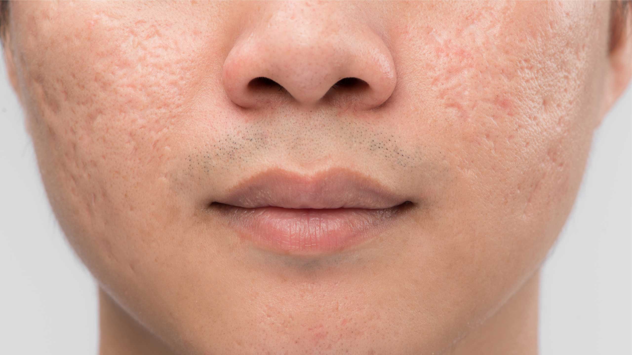 Acne Scarring
