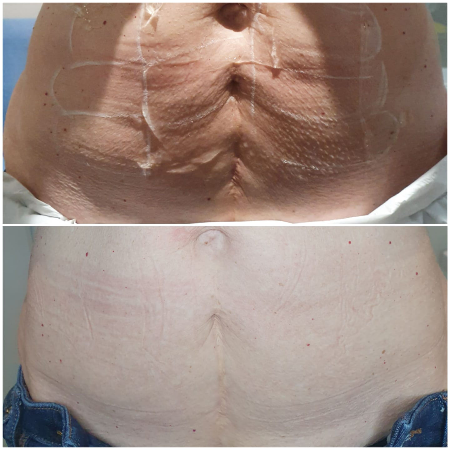 HIFU Body