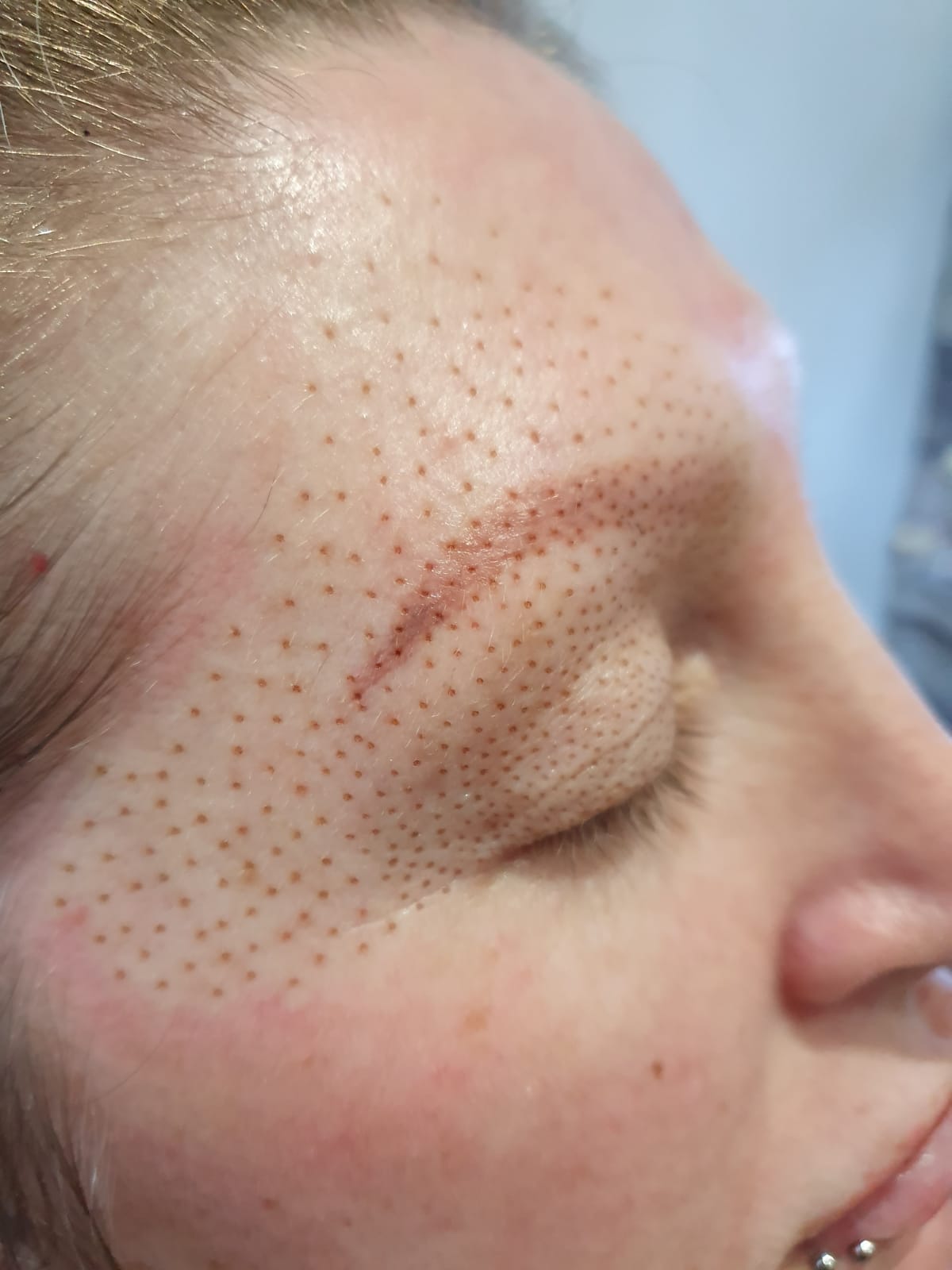 Plasma Soft Surgery Under Eye or Hooded Eye