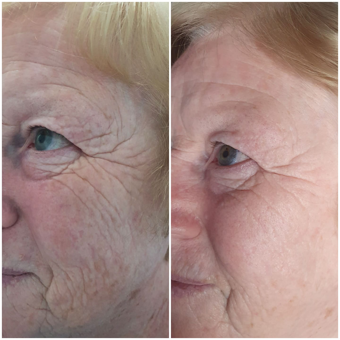 HIFU Face Plus £100 Free Skincare