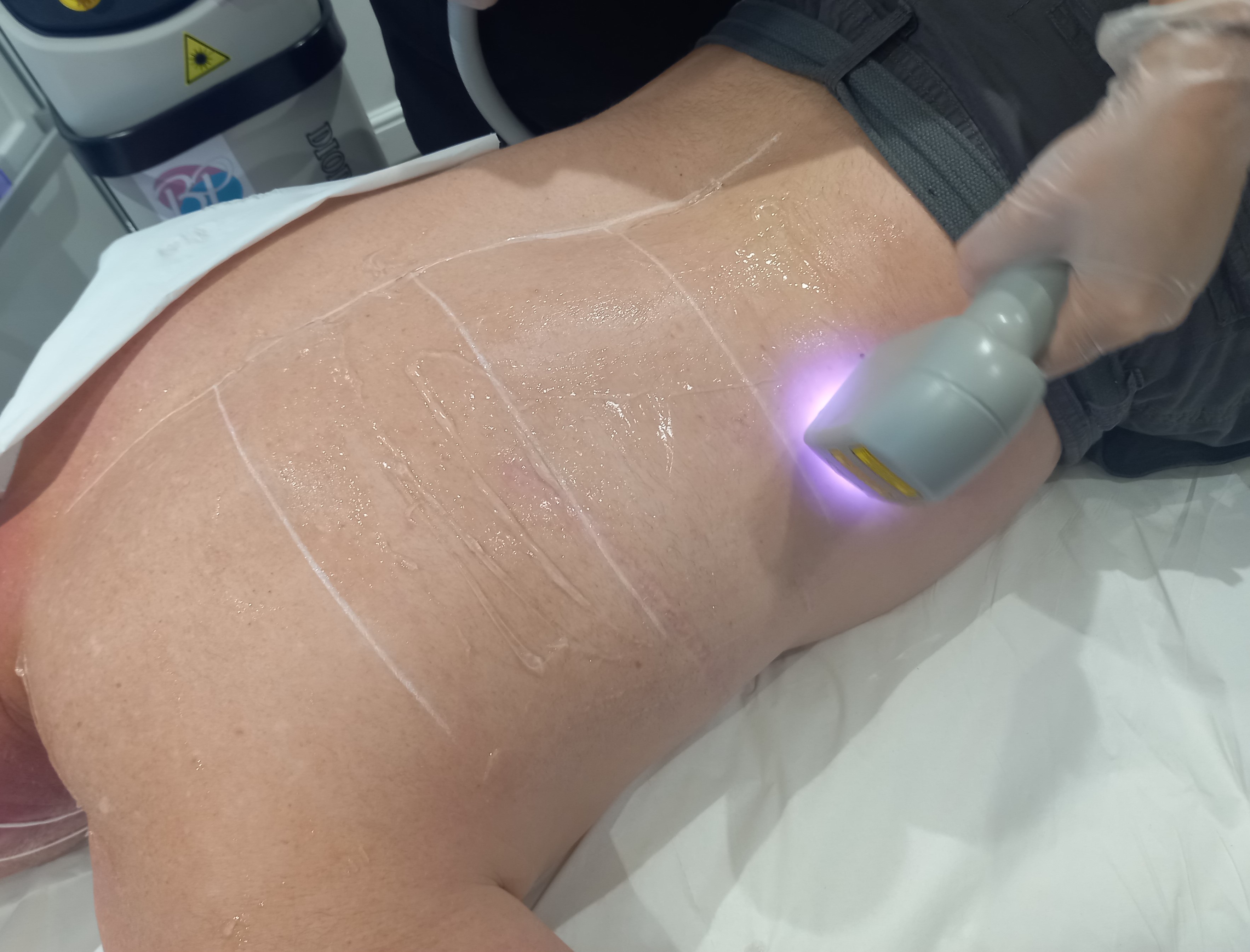 Laser Hair Reduction