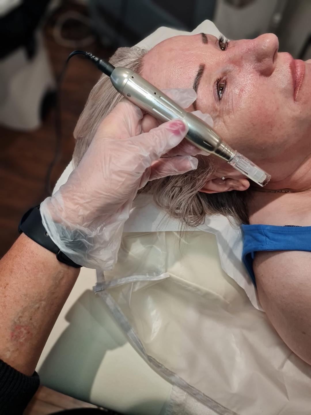 Derma FNS Face x 3 Treatments