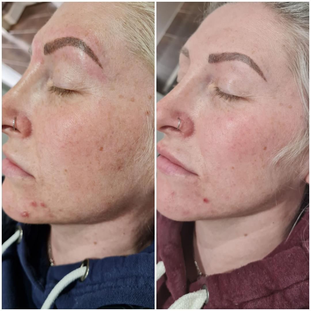 Bespoke Peel for Anti-ageing and Pigmentation