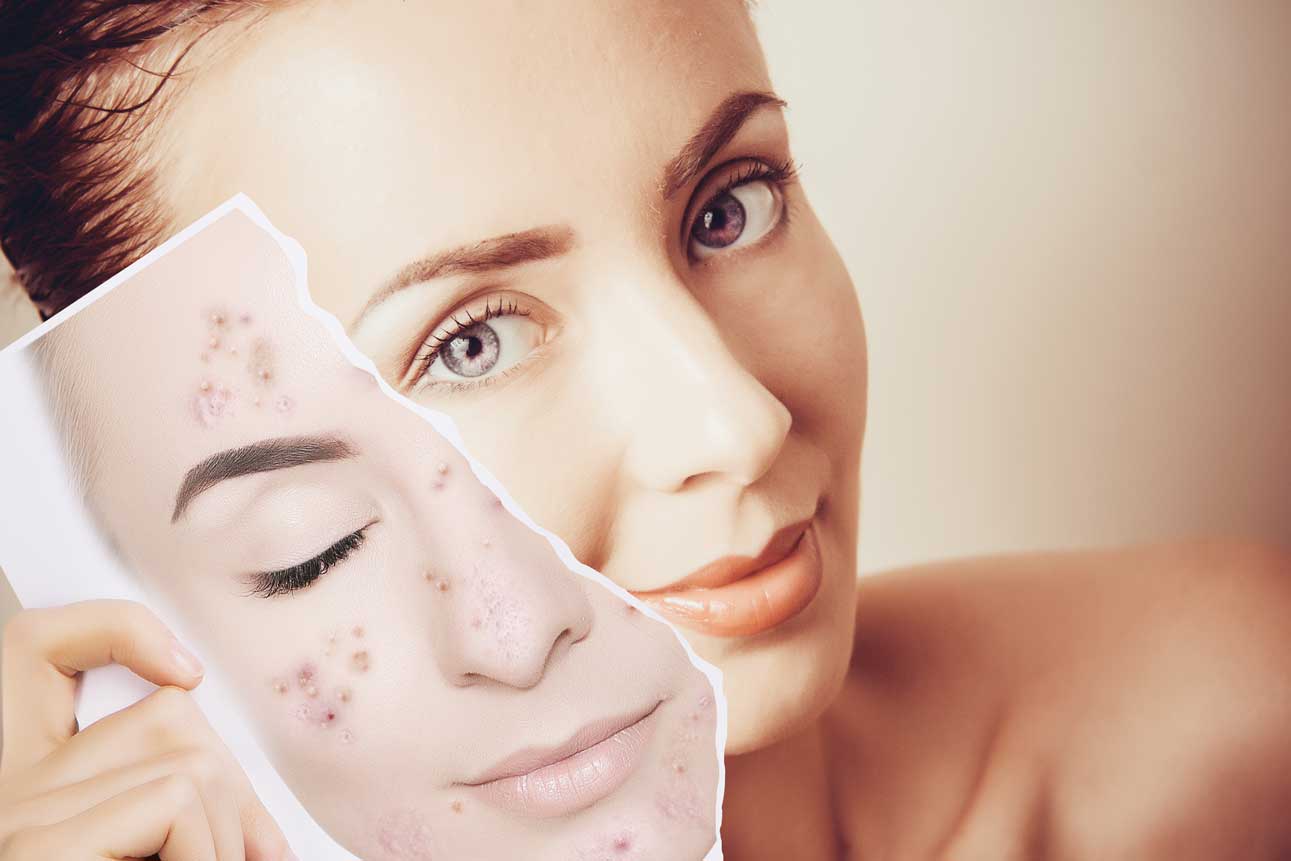 Any 3 Peels For £200