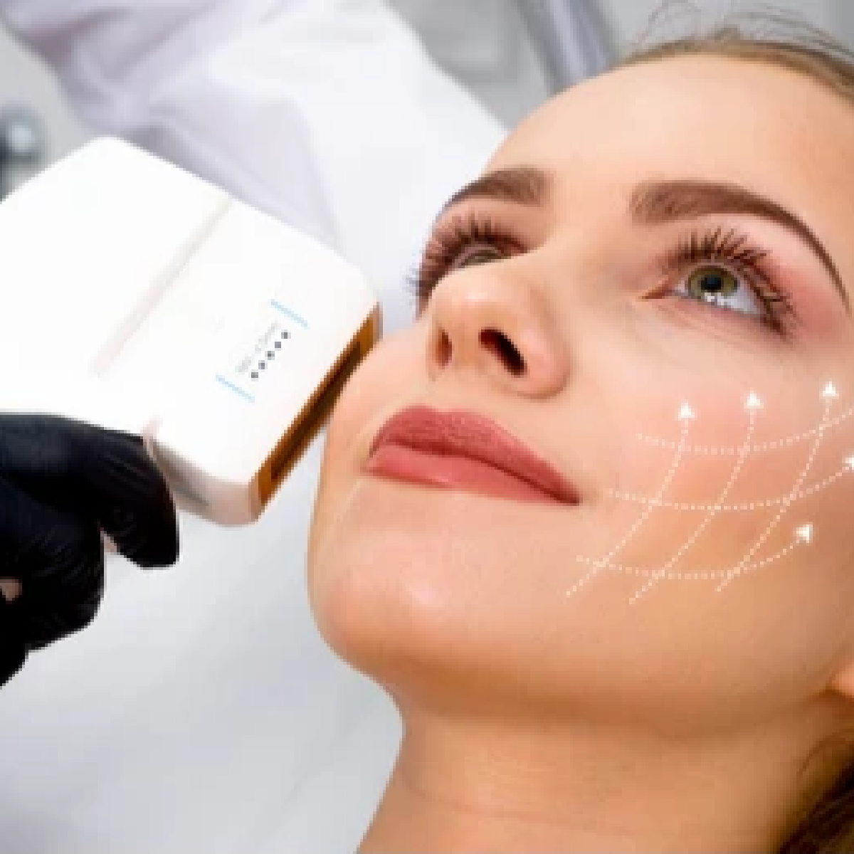 HIFU Full Face/Neck & Plasma/Fibroblast