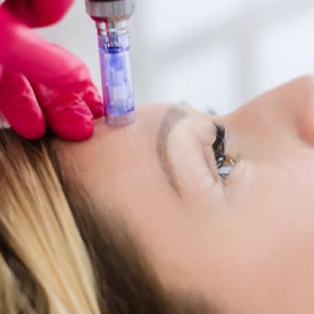 Mandelic Peel & Derma FNS Medical Microneedling