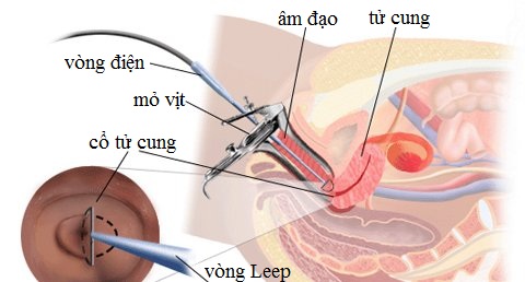 leep cổ tử cung