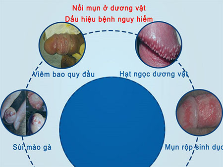moc mun duong vat do viem nhiem