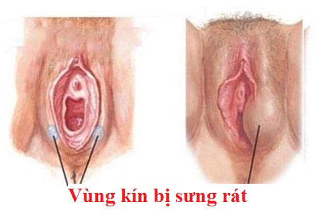 ngứa rát vùng kín