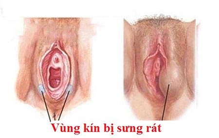vùng kín bị ngứa rát và sưng đỏ