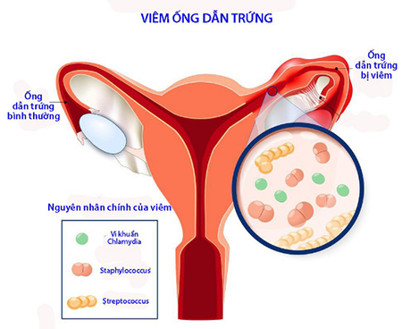viêm ống dẫn trứng